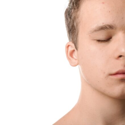 L’ACNE DES 10-17 ANS